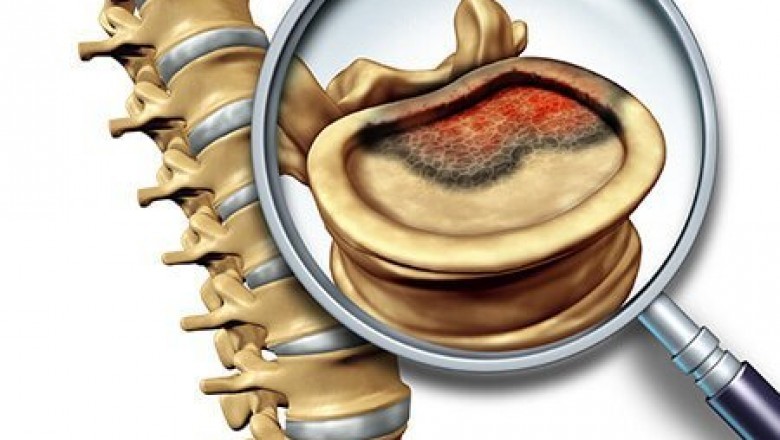 The high prevalence of bone cancer, as well as the development and approval of novel therapies, are expected to boost the bone cancer treatment market
