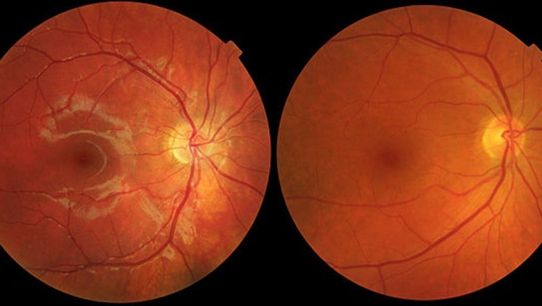 Age-related Macular degeneration usually affects the central portion of the eye, resulting in a blind spot in the visual field's middle