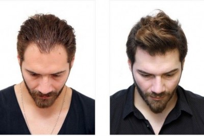 What Creates a Hair Transplant Successful?