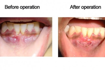 FRENOTOMY USING DIODE LASER