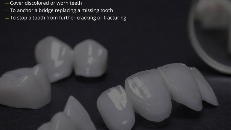 Need of a Dental Crown | Best Emergency Dentists
