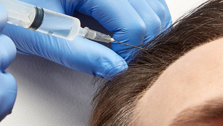 PRP Treatment In Delhi | PRP treatment cost in Delhi NCR India