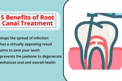 Benefits of Root Canal Treatment | Best Emergency Dentist Near You