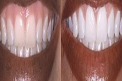 Zoom Teeth Whitening