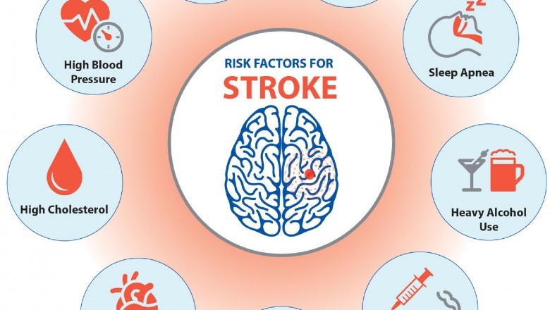 Risk Factors for Stroke | Best Mini Stroke Treatment
