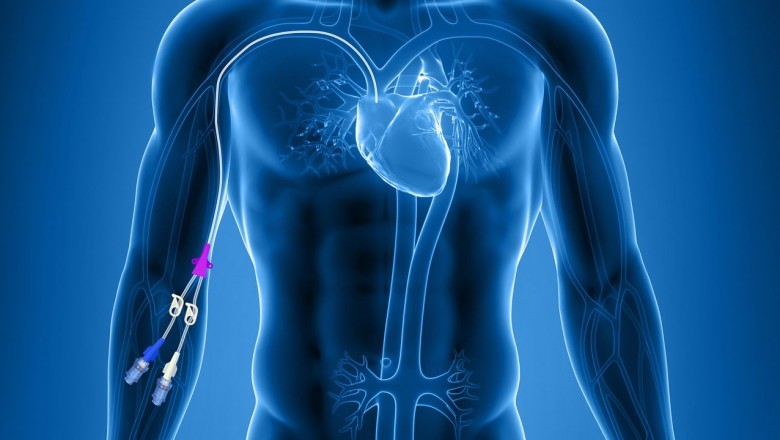 To obtain central access through peripheral veins, the tip of a peripherally implanted central catheter is used.