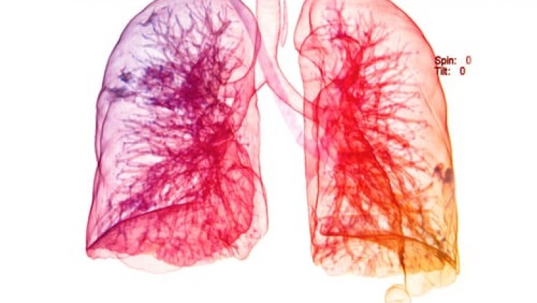 What are various respiratory distress syndrome treatment available in market today?