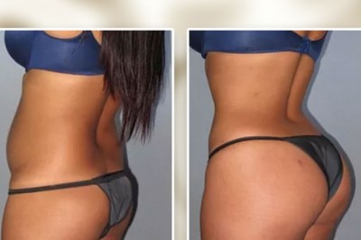 Why do we need Cavitation Machines For Fat Burning And Body Sculpting?