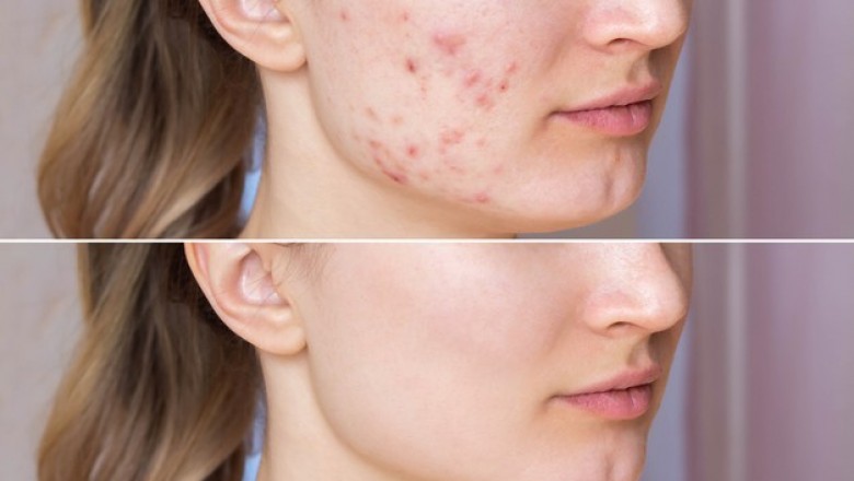 Melasma: Diagnosis and treatment - Dr. Jyoti Sharma