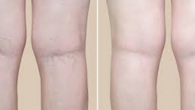 Spider Veins Treatments Near Me
