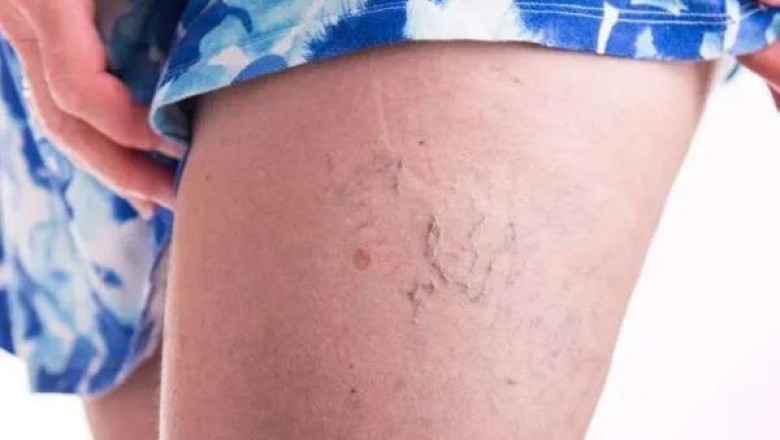 Are Varicose Veins and Spider Veins Dissimilar?