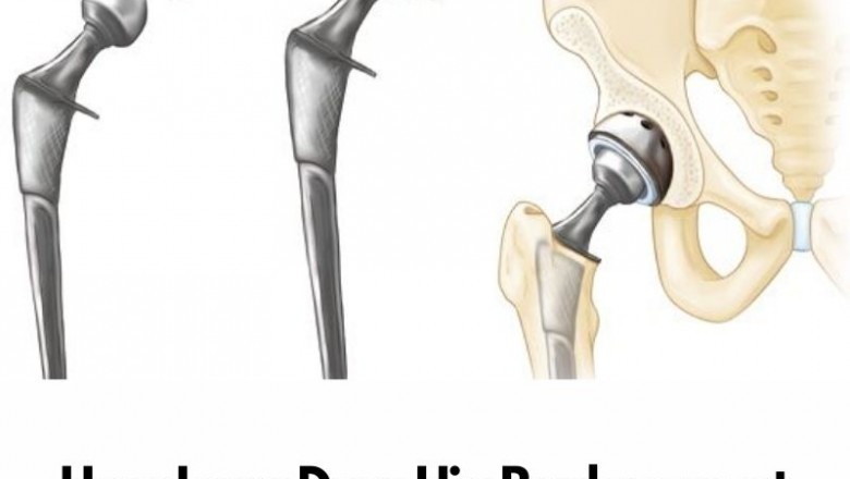 How Long Does Hip Replacement Surgery Take