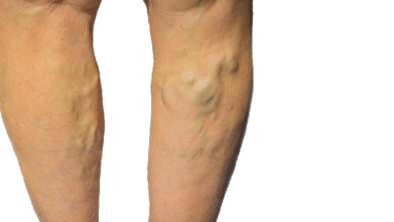 In What Way Varicose Veins and Spider Veins Get Identified?