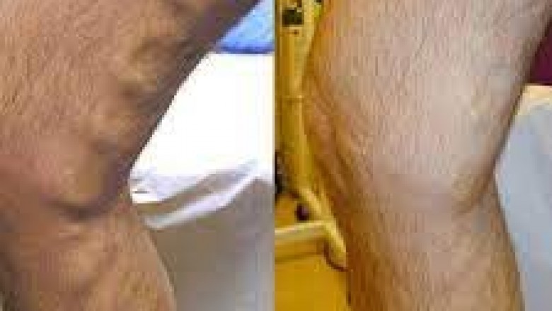 San Diego Veins Treatment Near Me