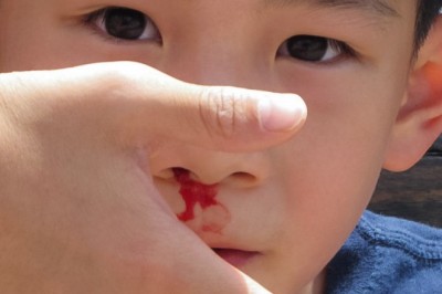Summer Nosebleed: What Causes It and How to Treat It