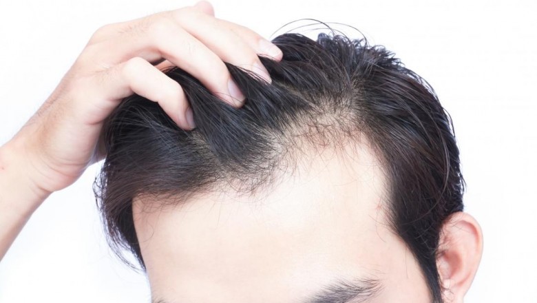 The Best Candidate for FUE Hair Transplants.
