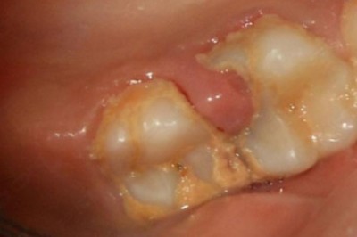 LASER ASSISTED EXCISION OF A GINGIVAL POLYP