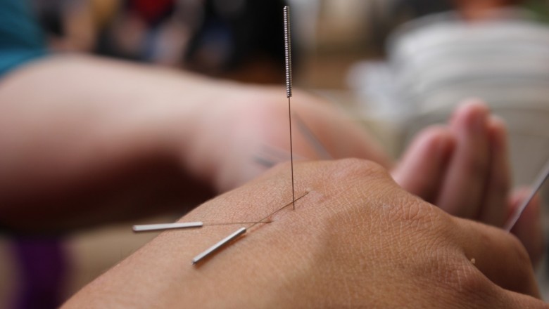Dry Needling Therapy for Pain Relief