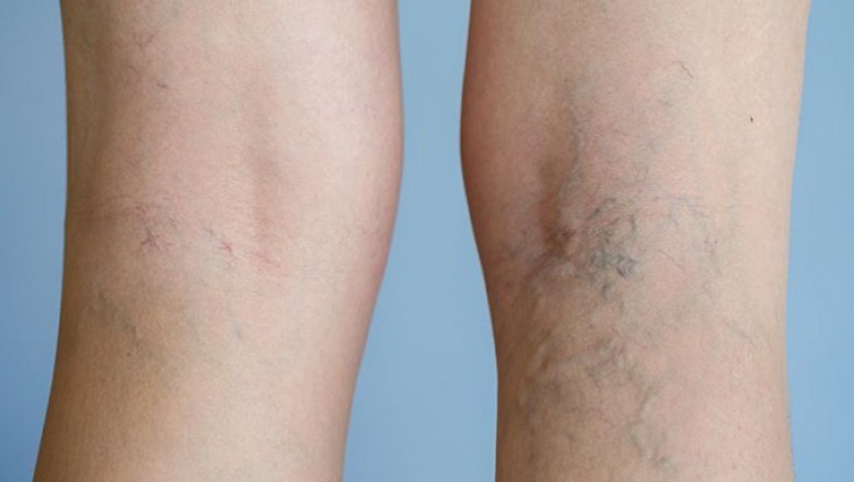 How to Find the Best Vein Treatment Center?