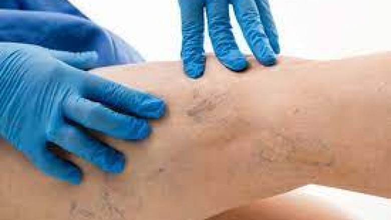 Veins Treatments Near Me