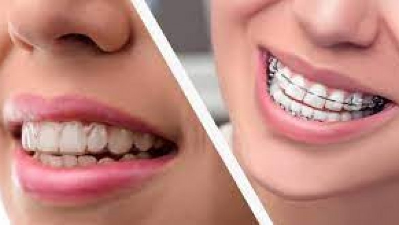 What are the different alternatives in dental braces?