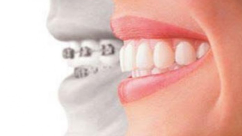 Which One Is Much Productive - Invisalign Or Braces?