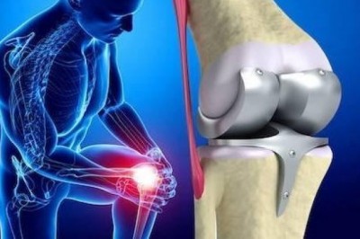 The global artificial joints market is oligopolistic, with a small number of companies dominating the majority of it.