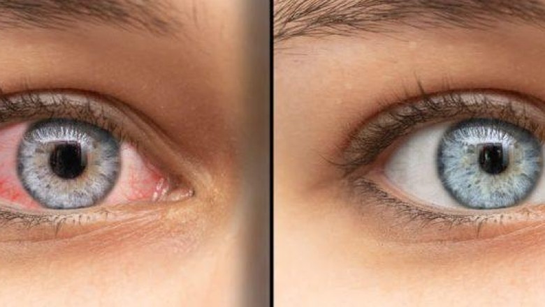 EYELID SURGERY: IMPORTANT FACTS YOU MUST KNOW ABOUT THE PROCEDURE