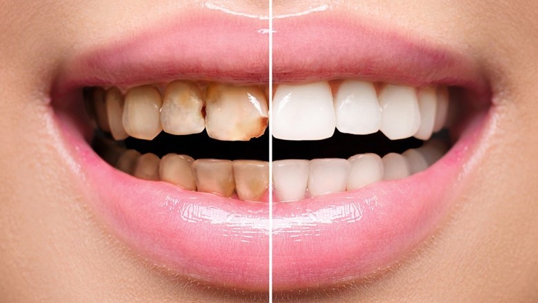 Full Mouth Dental Veneers: Get A Sparkling Smile