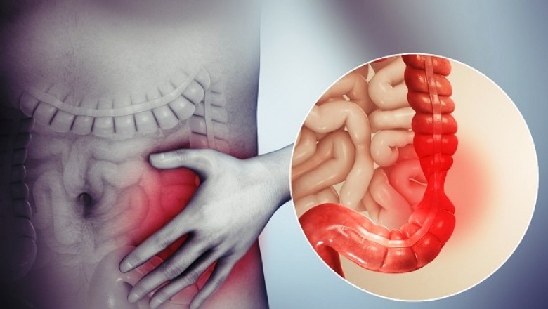 Irritable Bowel Syndrome Treatment involves the use of probiotics to reduce the symptoms such as severe abdominal pain associated with this condition