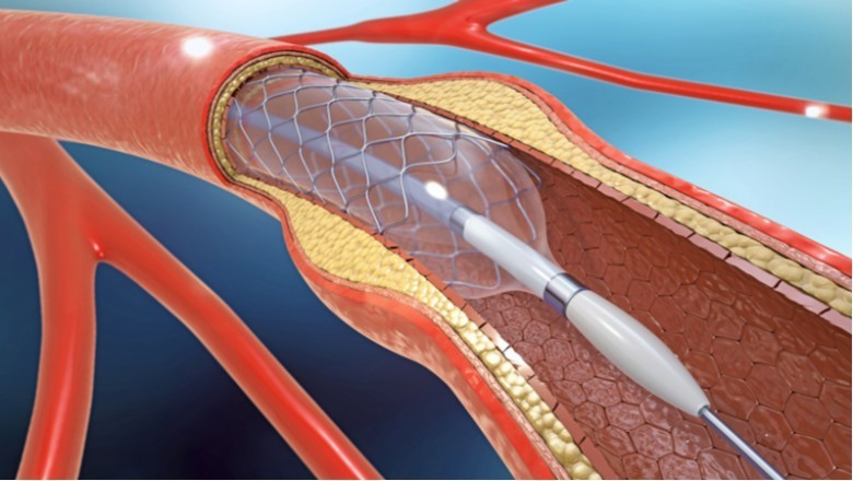 Major Players in Drug Eluting Stents Market Focus on R&D of New Generation of Everolimus-Eluting Coronary Stents