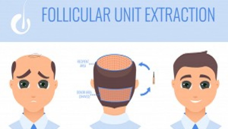 What Is An FUE Hair Transplant?