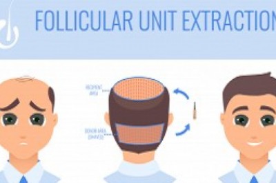 What Is An FUE Hair Transplant?
