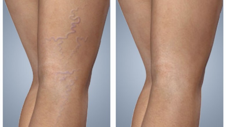 San Diego Veins Treatment