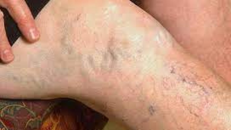 Are Varicose Veins and Spider Veins
