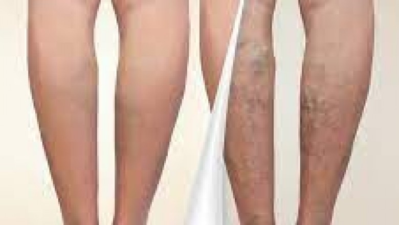 varicose vein treatment California