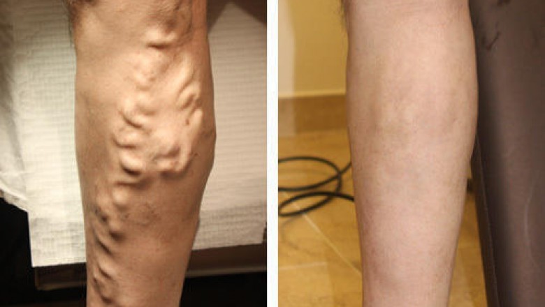 varicose vein treatment Manhattan