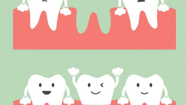 Wisdom Tooth Extraction- My Gentle Dentist