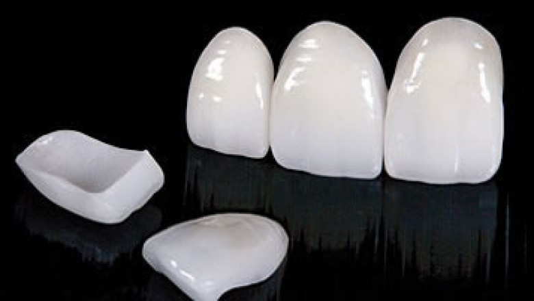 All-ceramic Dental Crowns are gaining popularity because they can mimic the quality of natural teeth while also blending in with the surrounding teeth