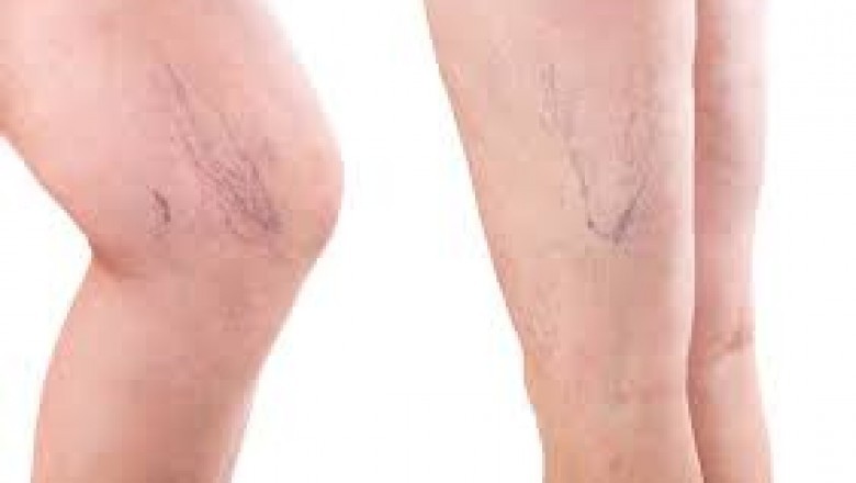 Paramus Varicose Vein Treatment Near Me