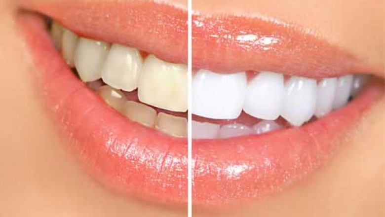 Professional Teeth Whitening Cost