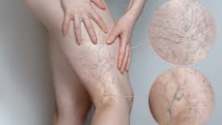 What are the Best Three Spider Vein Treatments Available?