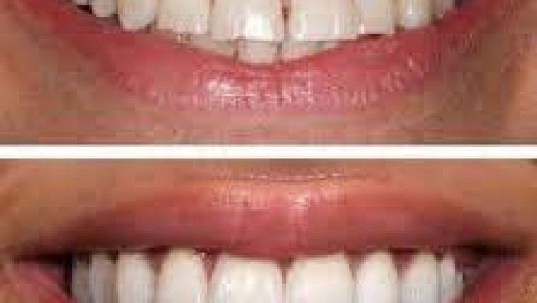 When Do You Need Teeth Veneers?