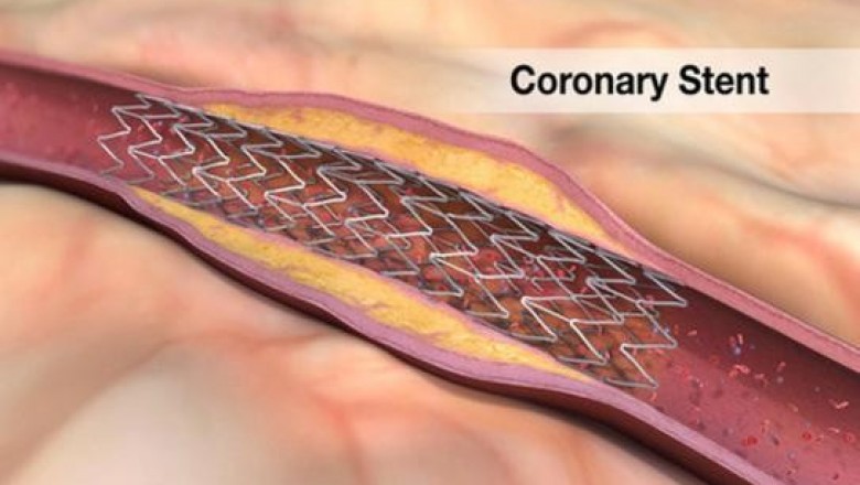 Gel Stent Market Size, Share, Outlook, and Opportunity Analysis, 2019– 2027