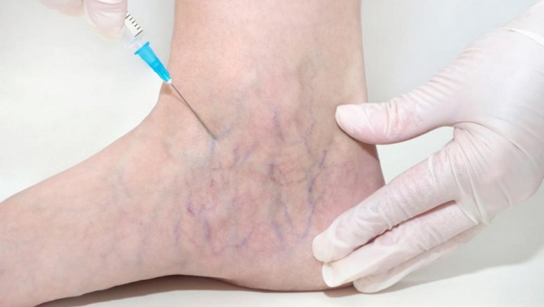 SpiderVein Treatment: Reduce The Appearance Of The Unsightly Veins.
