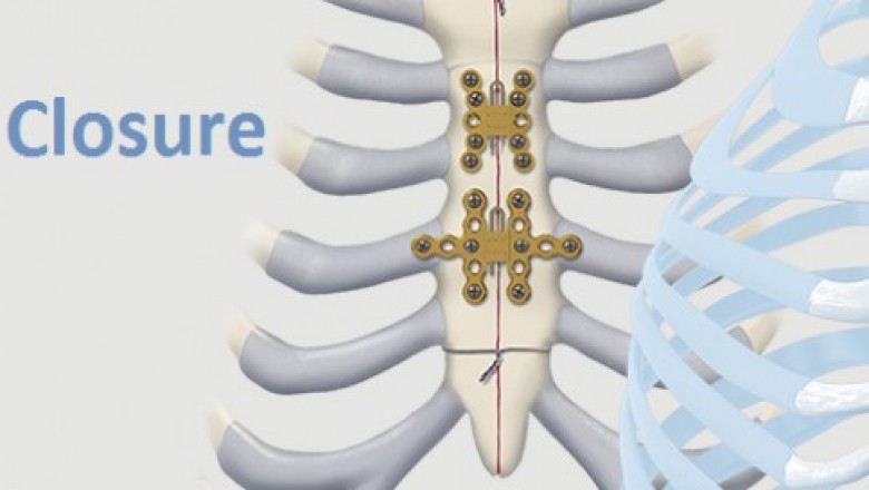 Sternal Closure Systems Market Size, Trends, Shares, Insights and Forecast – 2018-2026