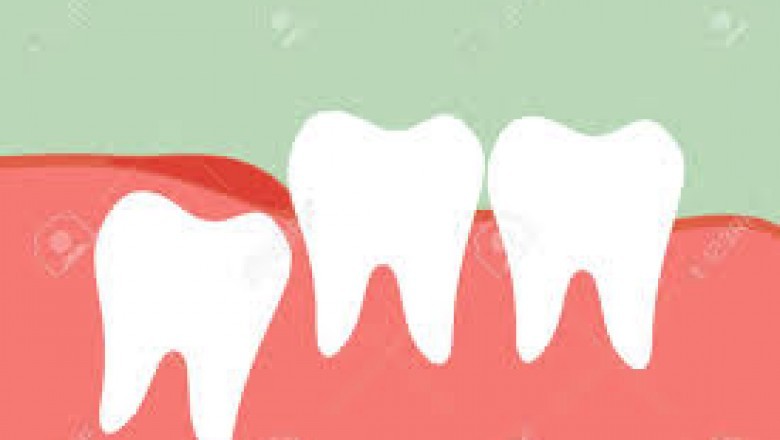 How Dental Lumineers Can Help You?