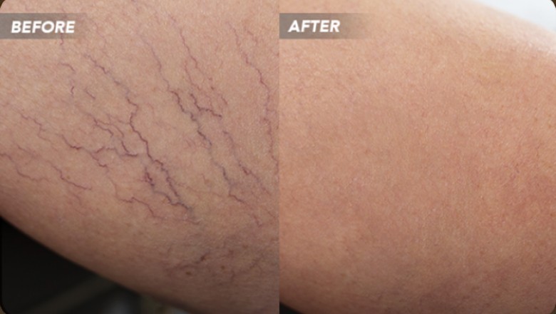 Is It True That Laser Varicose Vein Treatment Permanently Remove the Problem?