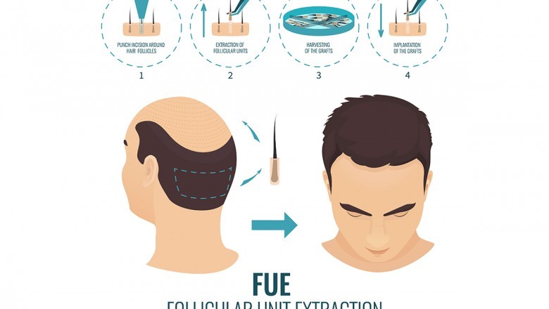 FUE Hair Transplant Surgery and Age.