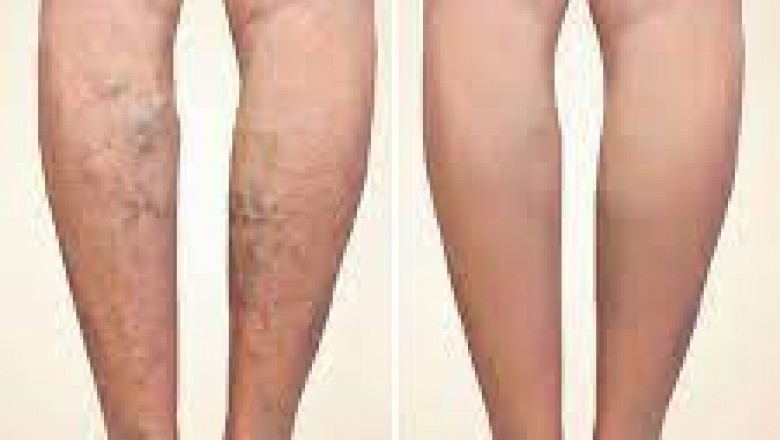 How To Choose The Right Vein Doctor